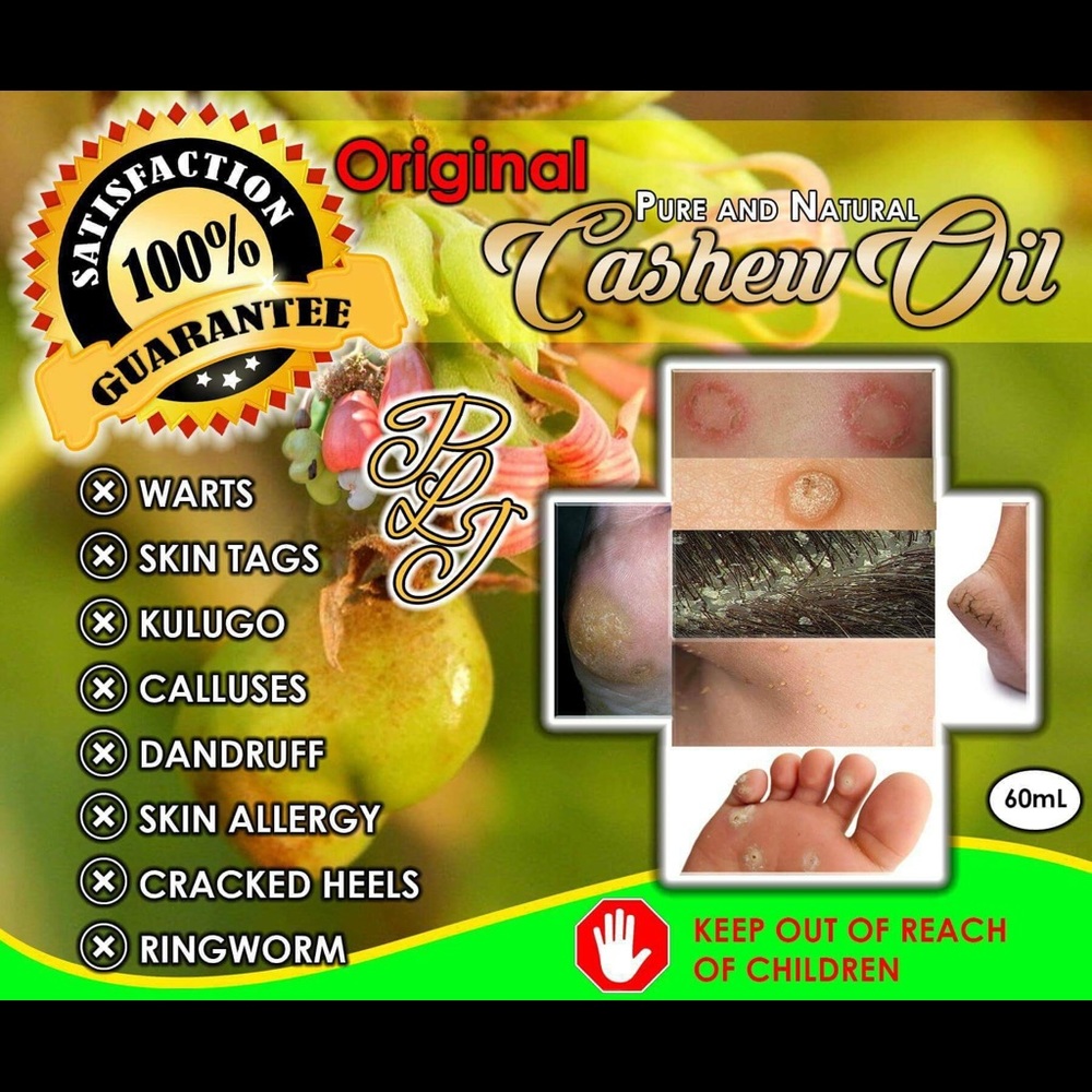 Cashew Oil For Warts, Skin Tag, Kalugo, Calluses